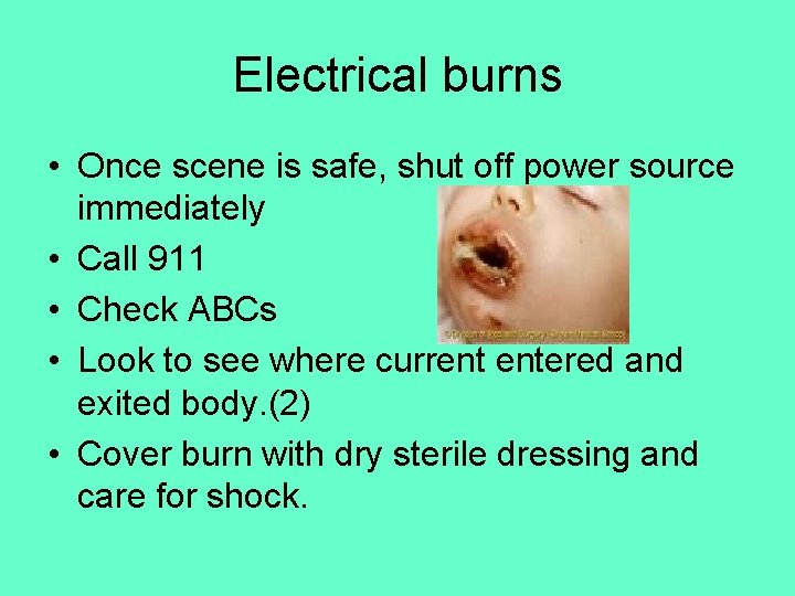 Electrical burns • Once scene is safe, shut off power source immediately • Call