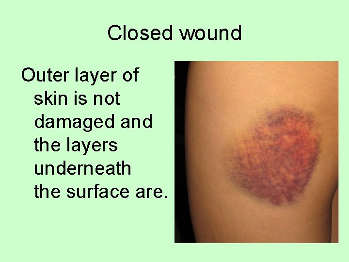 Closed wound Outer layer of skin is not damaged and the layers underneath the