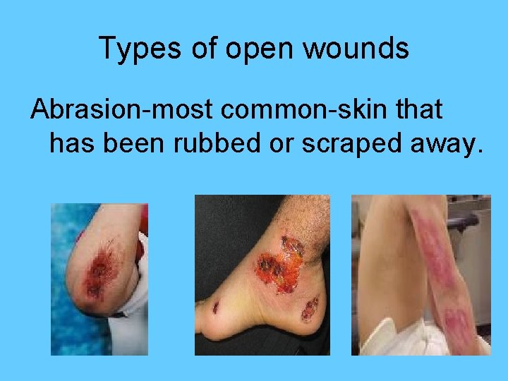 Types of open wounds Abrasion-most common-skin that has been rubbed or scraped away. 