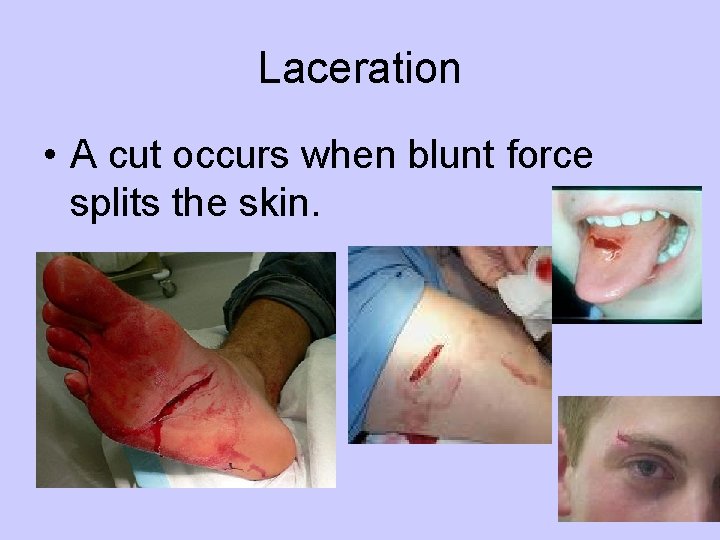 Laceration • A cut occurs when blunt force splits the skin. 