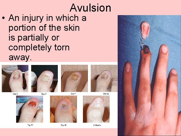 Avulsion • An injury in which a portion of the skin is partially or