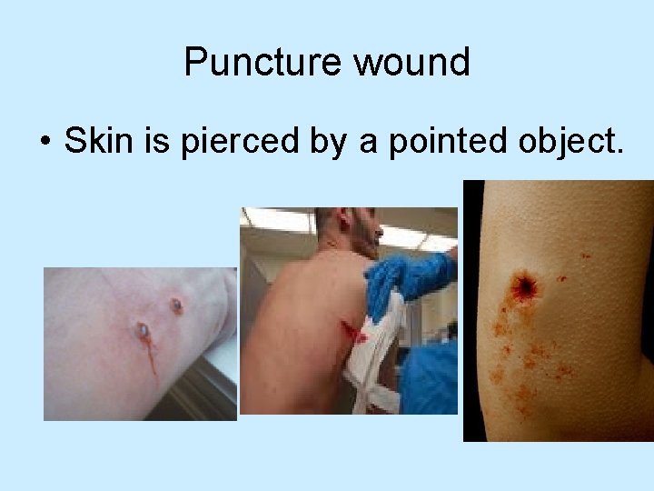 Puncture wound • Skin is pierced by a pointed object. 