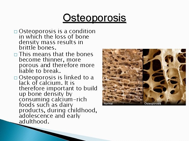 Osteoporosis is a condition in which the loss of bone density mass results in