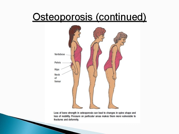 Osteoporosis (continued) 