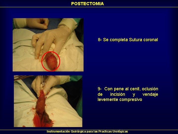 POSTECTOMIA 8 - Se completa Sutura coronal 9 - Con pene al cenit, oclusión POSTECTOMIA 8 - Se completa Sutura coronal 9 - Con pene al cenit, oclusión