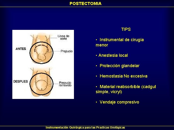 POSTECTOMIA TIPS • Instrumental de cirugía menor • Anestesia local • Protección glandelar • POSTECTOMIA TIPS • Instrumental de cirugía menor • Anestesia local • Protección glandelar •