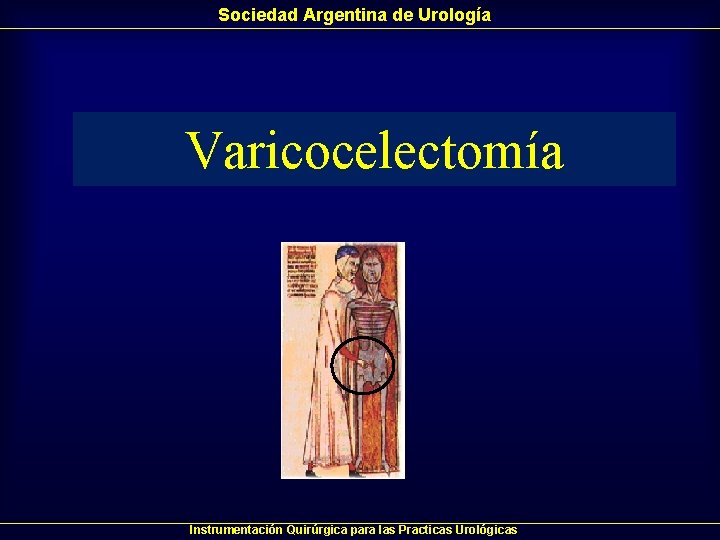Sociedad Argentina de Urología Varicocelectomía Instrumentación Quirúrgica para las Practicas Urológicas Sociedad Argentina de Urología Varicocelectomía Instrumentación Quirúrgica para las Practicas Urológicas