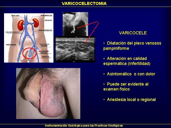 VARICOCELECTOMIA VARICOCELE • Dilatación del plexo venosos pampiniforme • Alteración en calidad espermática (Infertilidad) VARICOCELECTOMIA VARICOCELE • Dilatación del plexo venosos pampiniforme • Alteración en calidad espermática (Infertilidad)