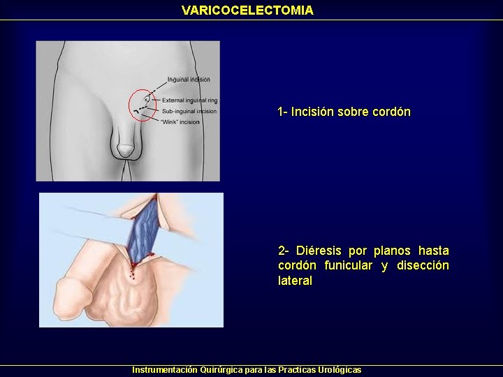 VARICOCELECTOMIA 1 - Incisión sobre cordón 2 - Diéresis por planos hasta cordón funicular VARICOCELECTOMIA 1 - Incisión sobre cordón 2 - Diéresis por planos hasta cordón funicular