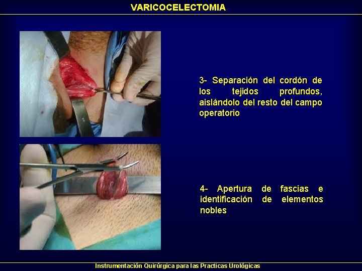 VARICOCELECTOMIA 3 - Separación del cordón de los tejidos profundos, aislándolo del resto del VARICOCELECTOMIA 3 - Separación del cordón de los tejidos profundos, aislándolo del resto del
