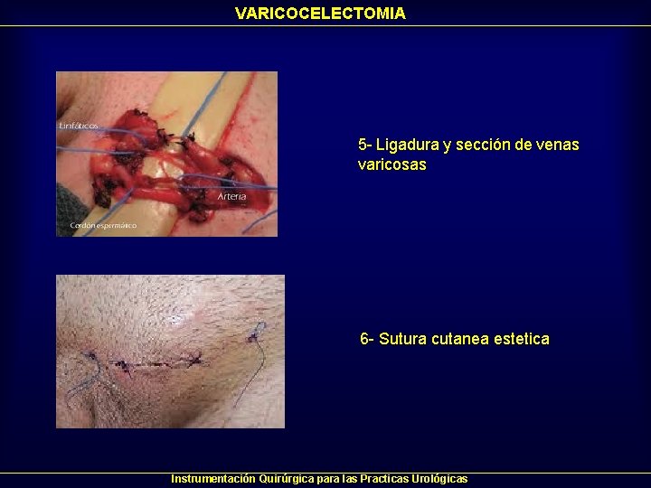 VARICOCELECTOMIA 5 - Ligadura y sección de venas varicosas 6 - Sutura cutanea estetica VARICOCELECTOMIA 5 - Ligadura y sección de venas varicosas 6 - Sutura cutanea estetica