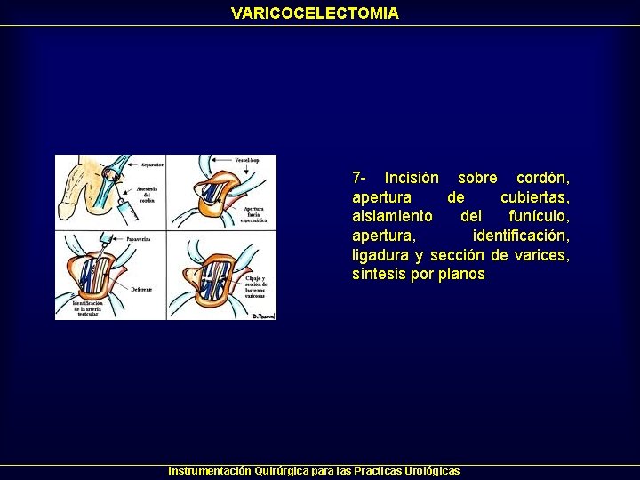 VARICOCELECTOMIA 7 - Incisión sobre cordón, apertura de cubiertas, aislamiento del funículo, apertura, identificación, VARICOCELECTOMIA 7 - Incisión sobre cordón, apertura de cubiertas, aislamiento del funículo, apertura, identificación,