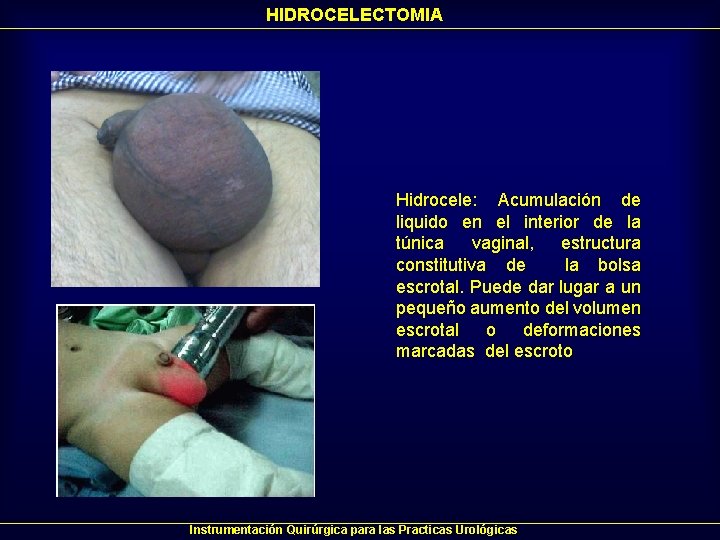 HIDROCELECTOMIA Hidrocele: Acumulación de liquido en el interior de la túnica vaginal, estructura constitutiva HIDROCELECTOMIA Hidrocele: Acumulación de liquido en el interior de la túnica vaginal, estructura constitutiva