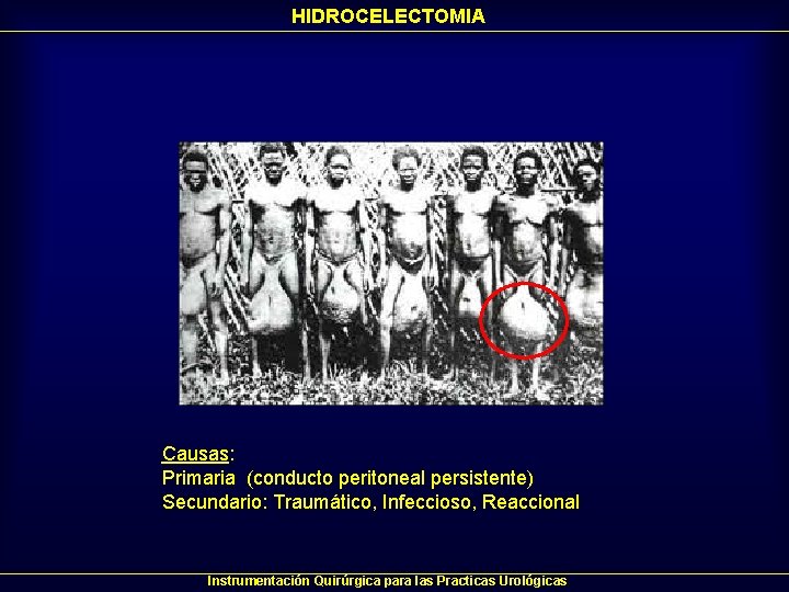 HIDROCELECTOMIA Causas: Primaria (conducto peritoneal persistente) Secundario: Traumático, Infeccioso, Reaccional Instrumentación Quirúrgica para las HIDROCELECTOMIA Causas: Primaria (conducto peritoneal persistente) Secundario: Traumático, Infeccioso, Reaccional Instrumentación Quirúrgica para las