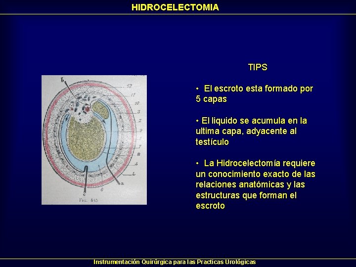 HIDROCELECTOMIA TIPS • El escroto esta formado por 5 capas • El liquido se HIDROCELECTOMIA TIPS • El escroto esta formado por 5 capas • El liquido se