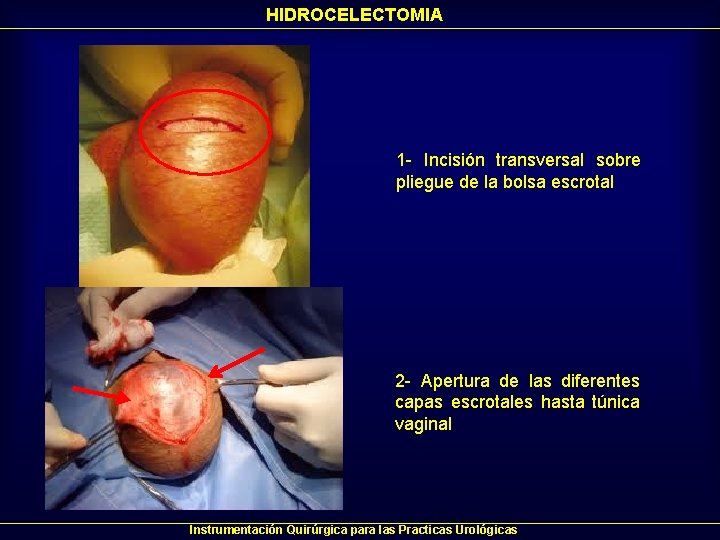 HIDROCELECTOMIA 1 - Incisión transversal sobre pliegue de la bolsa escrotal 2 - Apertura HIDROCELECTOMIA 1 - Incisión transversal sobre pliegue de la bolsa escrotal 2 - Apertura