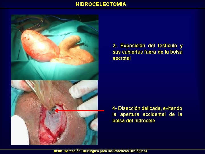 HIDROCELECTOMIA 3 - Exposición del testículo y sus cubiertas fuera de la bolsa escrotal HIDROCELECTOMIA 3 - Exposición del testículo y sus cubiertas fuera de la bolsa escrotal