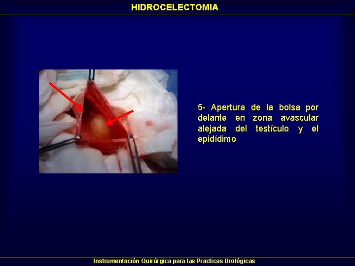 HIDROCELECTOMIA 5 - Apertura de la bolsa por delante en zona avascular alejada del HIDROCELECTOMIA 5 - Apertura de la bolsa por delante en zona avascular alejada del