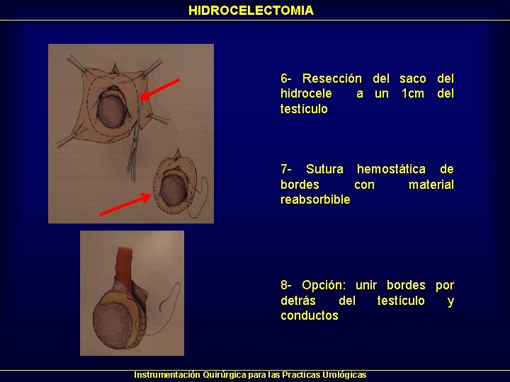 HIDROCELECTOMIA 6 - Resección del saco del hidrocele a un 1 cm del testículo HIDROCELECTOMIA 6 - Resección del saco del hidrocele a un 1 cm del testículo