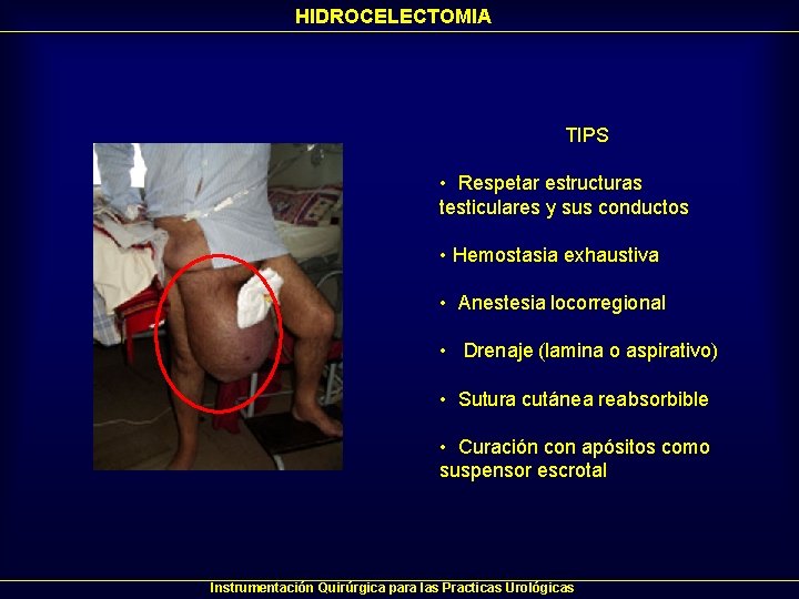 HIDROCELECTOMIA TIPS • Respetar estructuras testiculares y sus conductos • Hemostasia exhaustiva • Anestesia HIDROCELECTOMIA TIPS • Respetar estructuras testiculares y sus conductos • Hemostasia exhaustiva • Anestesia