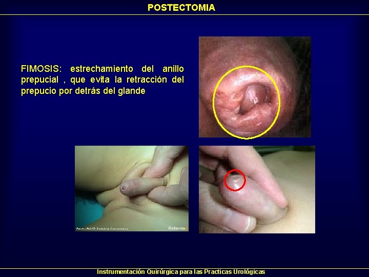 POSTECTOMIA FIMOSIS: estrechamiento del anillo prepucial , que evita la retracción del prepucio por POSTECTOMIA FIMOSIS: estrechamiento del anillo prepucial , que evita la retracción del prepucio por