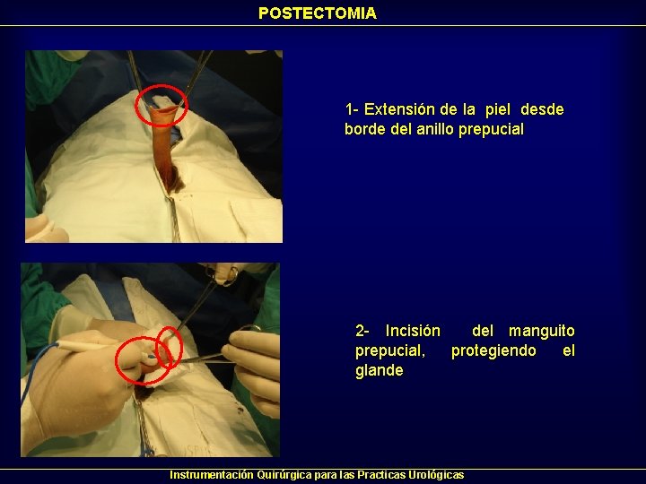 POSTECTOMIA 1 - Extensión de la piel desde borde del anillo prepucial 2 - POSTECTOMIA 1 - Extensión de la piel desde borde del anillo prepucial 2 -