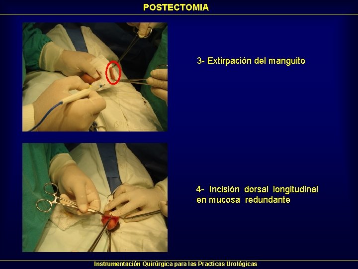POSTECTOMIA 3 - Extirpación del manguito 4 - Incisión dorsal longitudinal en mucosa redundante POSTECTOMIA 3 - Extirpación del manguito 4 - Incisión dorsal longitudinal en mucosa redundante