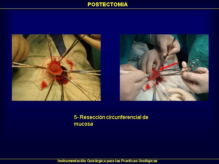 POSTECTOMIA 5 - Resección circunferencial de mucosa Instrumentación Quirúrgica para las Practicas Urológicas POSTECTOMIA 5 - Resección circunferencial de mucosa Instrumentación Quirúrgica para las Practicas Urológicas