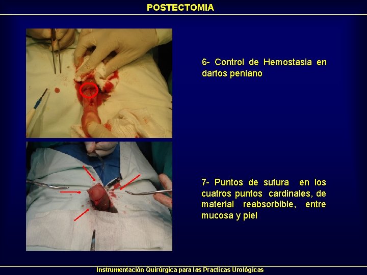 POSTECTOMIA 6 - Control de Hemostasia en dartos peniano 7 - Puntos de sutura POSTECTOMIA 6 - Control de Hemostasia en dartos peniano 7 - Puntos de sutura
