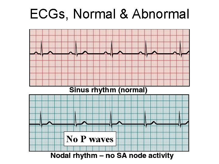 ECGs, Normal & Abnormal No P waves 