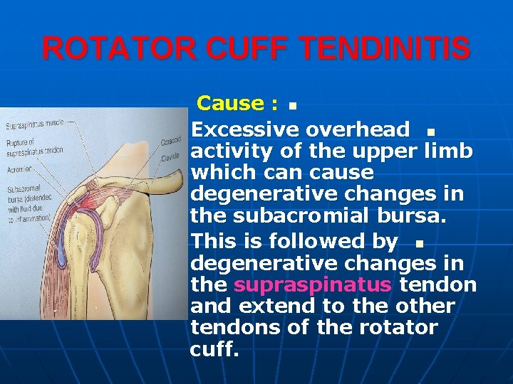 ROTATOR CUFF TENDINITIS Cause : n Excessive overhead n activity of the upper limb