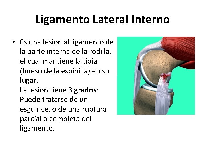 Ligamento Lateral Interno • Es una lesión al ligamento de la parte interna de