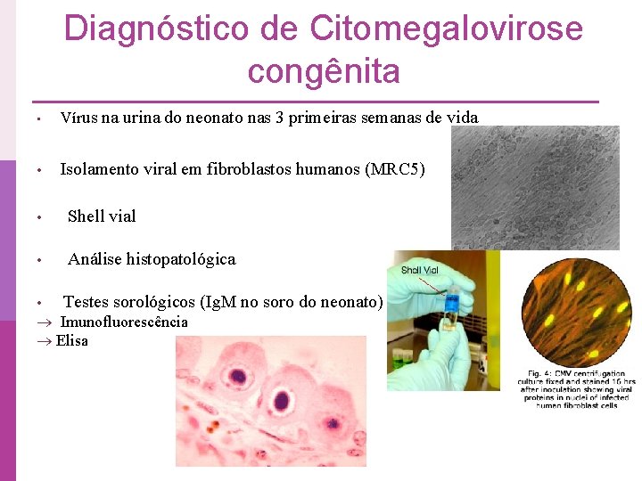 Diagnóstico de Citomegalovirose congênita • Vírus na urina do neonato nas 3 primeiras semanas