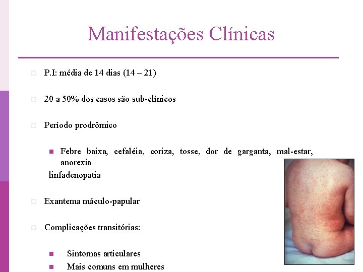 Manifestações Clínicas p P. I: média de 14 dias (14 – 21) p 20