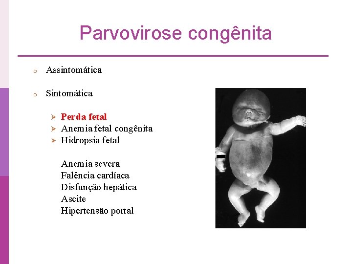 Parvovirose congênita o Assintomática o Sintomática Ø Ø Ø Perda fetal Anemia fetal congênita