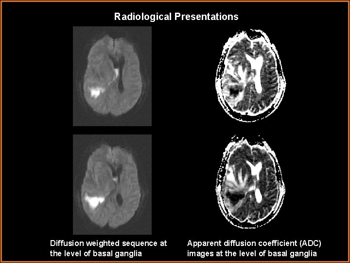 Radiological Presentations Diffusion weighted sequence at the level of basal ganglia Apparent diffusion coefficient