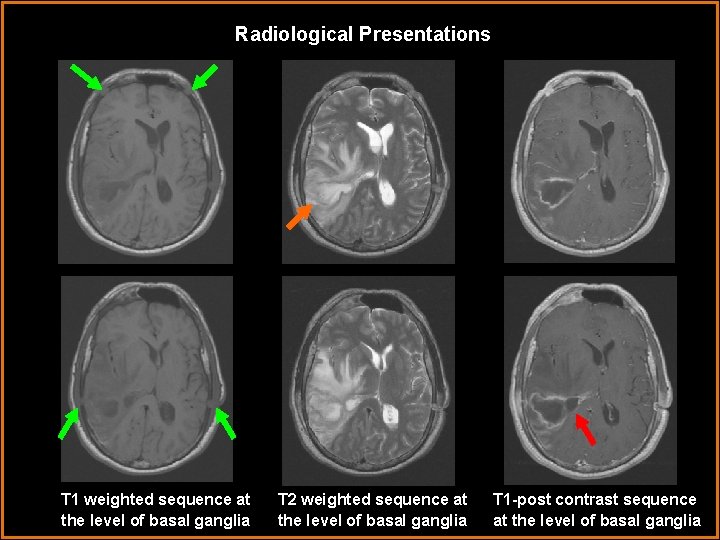 Radiological Presentations T 1 weighted sequence at the level of basal ganglia T 2