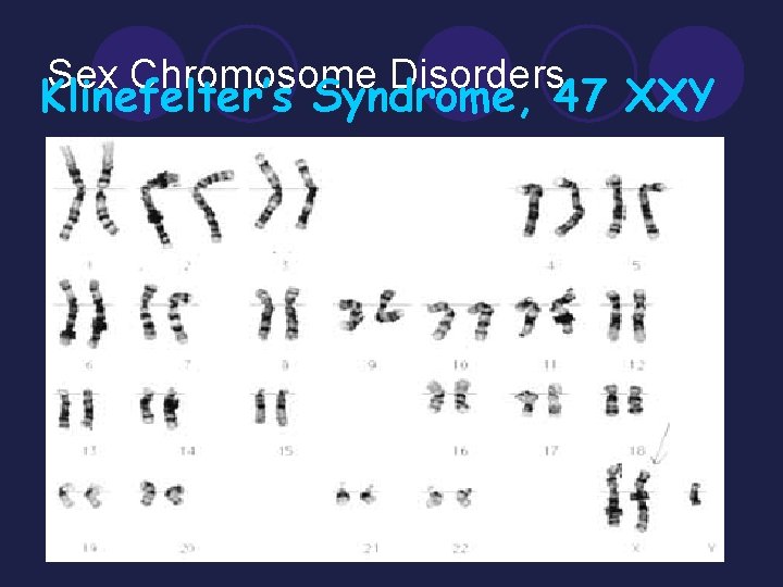 Sex Chromosome Disorders Klinefelter’s Syndrome, 47 XXY l Turner’s Syndrome (nondisjunction) ¡Female inherits only