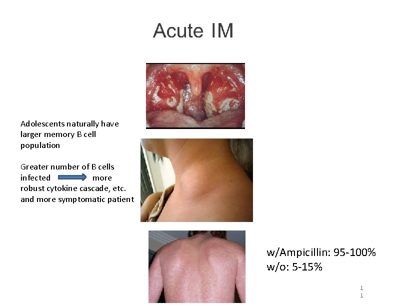 Adolescents naturally have larger memory B cell population Greater number of B cells infected Adolescents naturally have larger memory B cell population Greater number of B cells infected