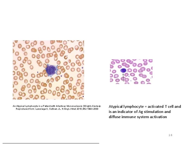 An Atypical Lymphocyte in a Patient with Infectious Mononucleosis (Wright–Giemsa). Reproduced from: Luzuriaga K, An Atypical Lymphocyte in a Patient with Infectious Mononucleosis (Wright–Giemsa). Reproduced from: Luzuriaga K,