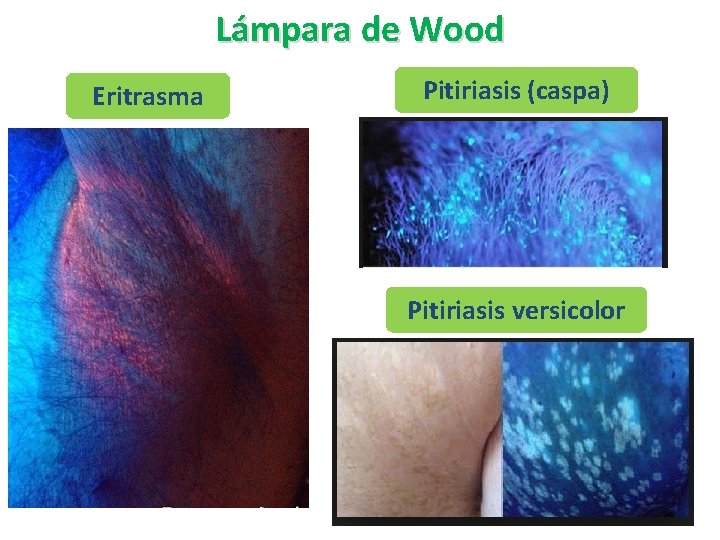 Lámpara de Wood Eritrasma Pitiriasis (caspa) Pitiriasis versicolor 