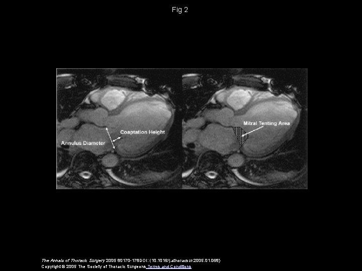 Fig 2 The Annals of Thoracic Surgery 2005 80170 -178 DOI: (10. 1016/j. athoracsur.