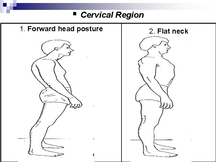 § Cervical Region 1. Forward head posture 2. Flat neck 