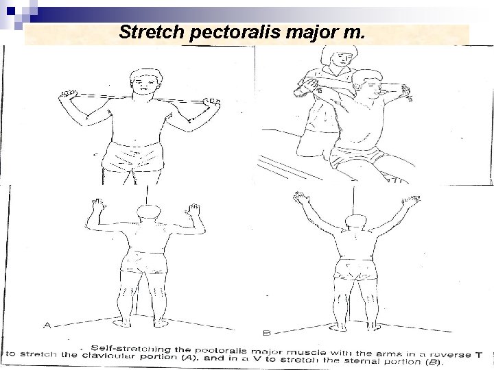Stretch pectoralis major m. n 