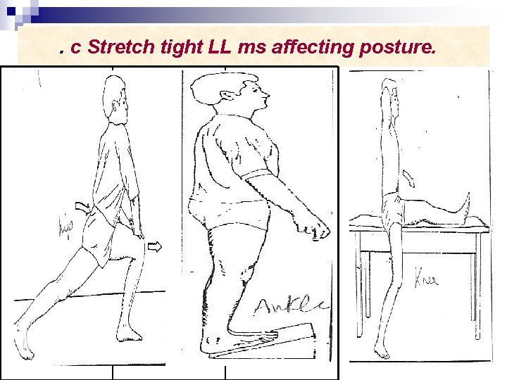 . c Stretch tight LL ms affecting posture. 