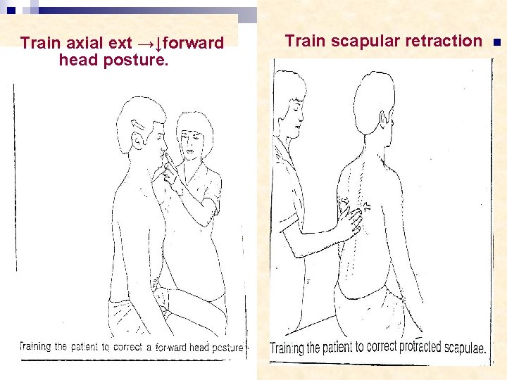 Train axial ext →↓forward head posture. Train scapular retraction n 