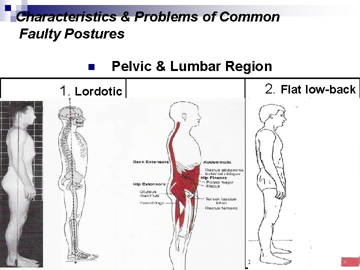 Characteristics & Problems of Common Faulty Postures n Pelvic & Lumbar Region 1. Lordotic