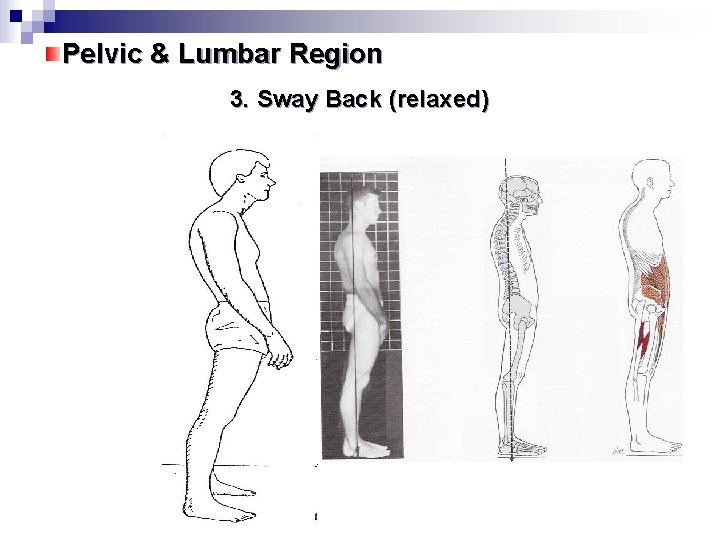 Pelvic & Lumbar Region 3. Sway Back (relaxed) 