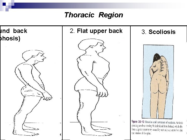 und back phosis) Thoracic Region 2. Flat upper back 3. Scoliosis 