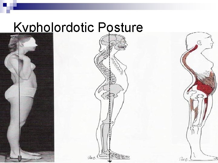 Kypholordotic Posture 